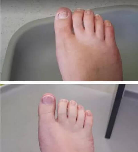 Adam Smith Podiatry Toenail Reconstruction